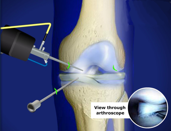 Диагностическая артроскопия коленного сустава
